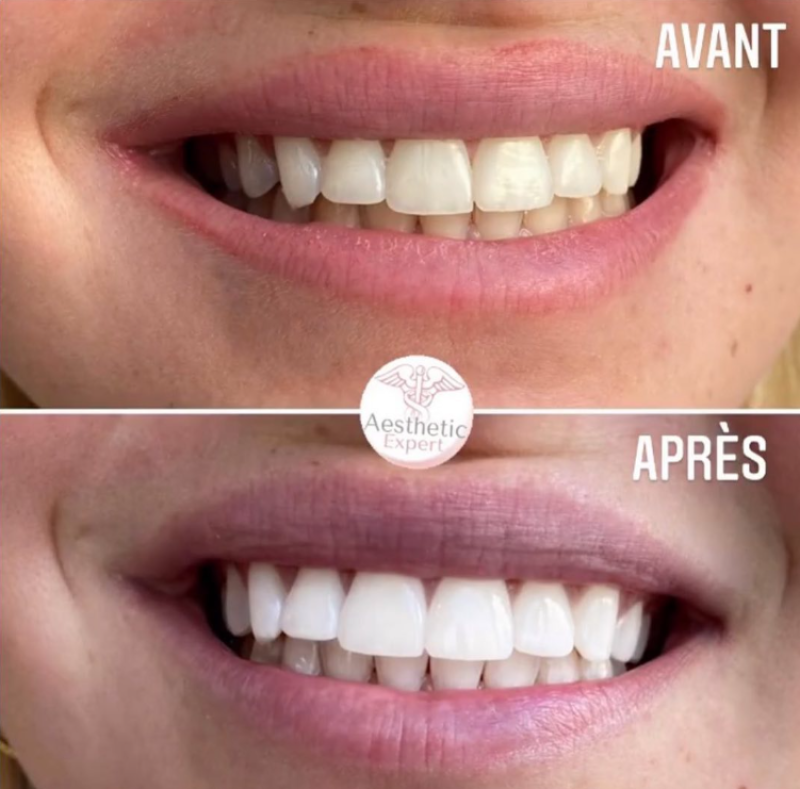 Formation professionnelle blanchiment dentaire à Marseille : soin esthétique des dents
