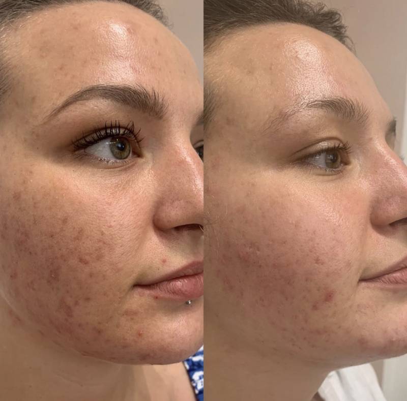 microneedling