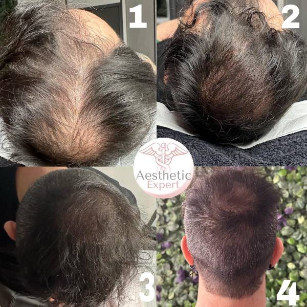 Formation professionnelle tricopigmentation à Marseille : correction capillaire